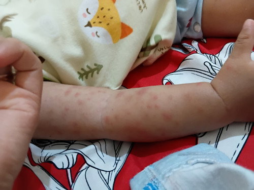 Ruam bentol di tangan