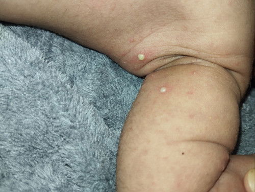 Bundaa ini anakku kenapa ya?🥹Cacar atau apa? ini di ketiak, trs di punggung juga ada🥹Kasian..🥹🥹