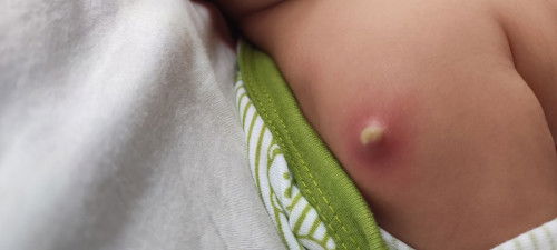 Vaksin BCG usia 2 bulan setelah 3 minggu bernanah tapi tidak pecah. Adakah bunda yg tau perawatannya