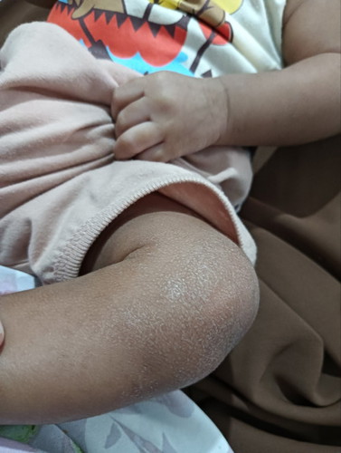Kulit baby kering mgelupas