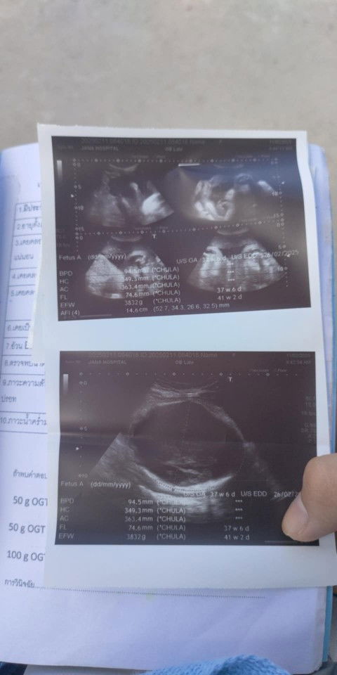 อายุครรภ์ 38+1W