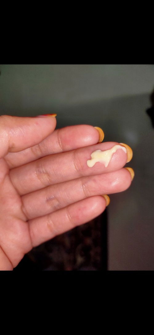 Keputihan menggumpal