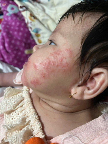 Bé nhà em bị chàm sữa , có cách nào điều trị hết khôg ak 😔