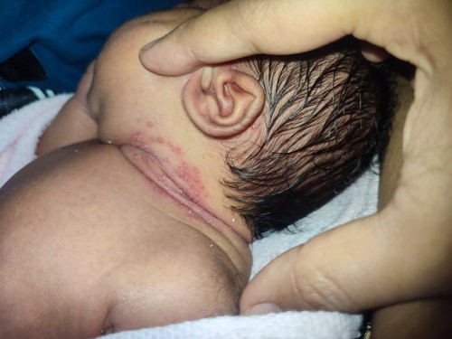 Ruam pada leher baby