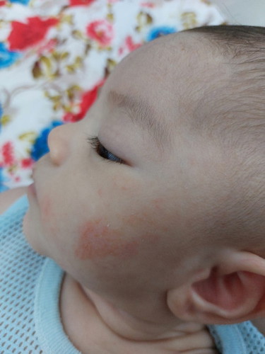 Ruam susu atau eczema