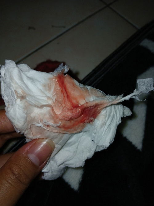 Plasenta ttupin jalan lahir