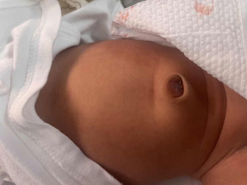 มีแม่ๆบ้านไหนสะดือเป็นนู้นๆแบบนี้ไหมคะ