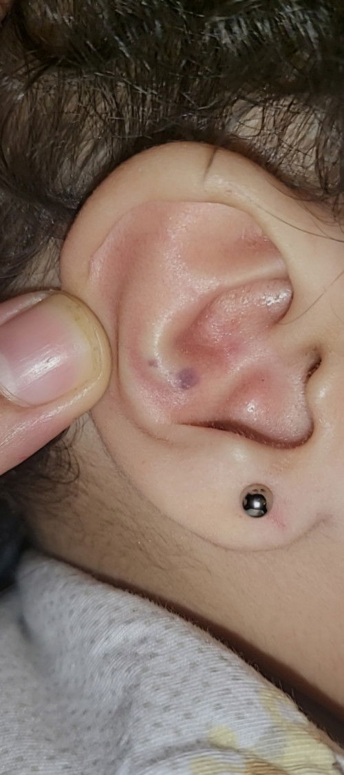 Bintik hitam di telinga