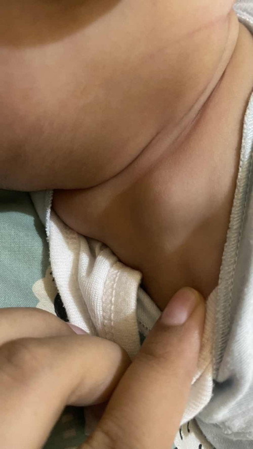 Benjolan pada bayi