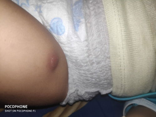 Bekas suntik imunisasi pcv 3 bengkak