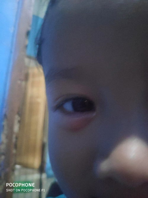 Anak sakit mata sudah 1 bulan