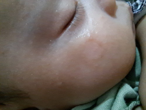 Ruam diwajah bayi