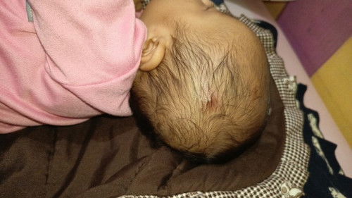 Benjolan merah ku eras seperti jerawat