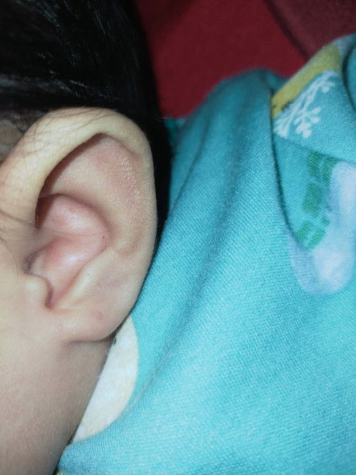 Adakah yang sama mom ini setelah tindik infeksi dan bernanh stlh kluar nanahncul benjolan kek gini