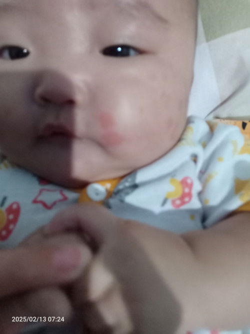 Bayi Alergi