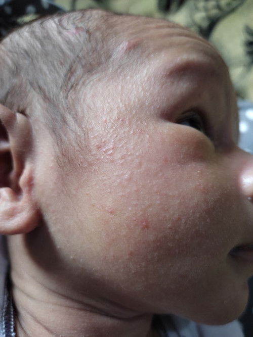 Wajah bayi bruntusan