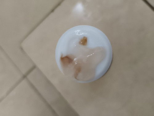 Apakah aman keputihan bercampur bercak darah seperti ini tapi tidak sedang hamil?