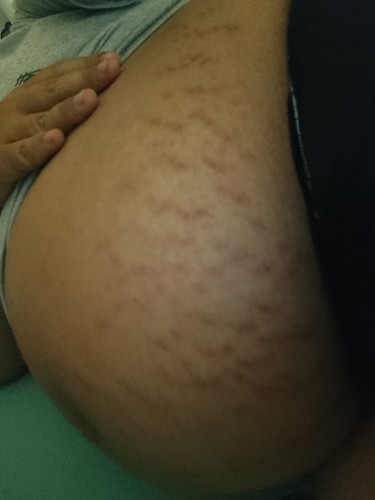 มีแม่ๆท่านไหนแตกขนาดนี้มั้ยคะ