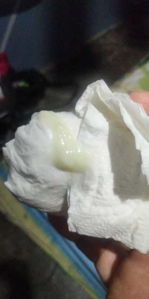 normal lng po b discharge na ganito??