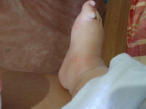 Rashes after Vaccination