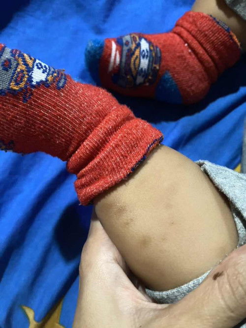 Cara ngilangin bekas gigitan nyamuk bayi pake apa ya bund?