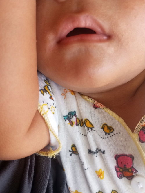 Putih2 dibawah bibir, kira2 kenapa ya bund