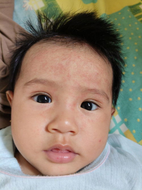 Bun mau tanya dong merah gini muka anak saya kenapa ya?