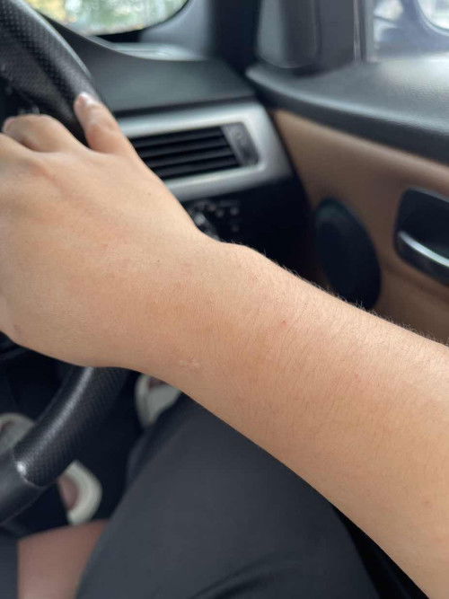 Gatal-gatal badan + stress