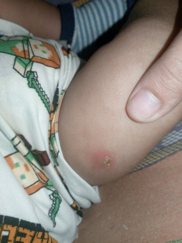 Tinurukan SI bby nung feb5 dalawang hita tinurok may nana Yung isnag hita TAs Ayan pumutok kanina
