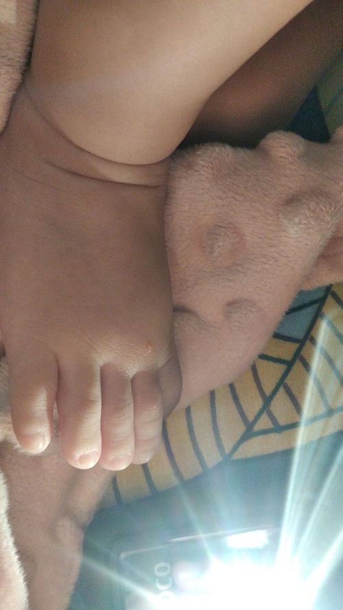 Bintik seperti berisi cairan berwarna bening di kaki bayi 3 bulan.
