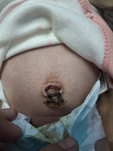 Umbilical Cord! Normal lang po ba ito or dpat na magworry?