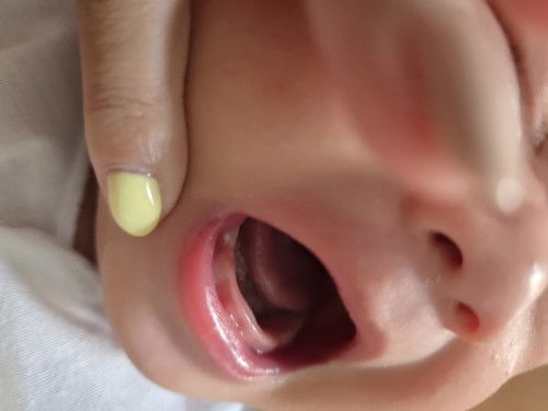 ฟันน้องกำลังจะขึ้นค่ะ