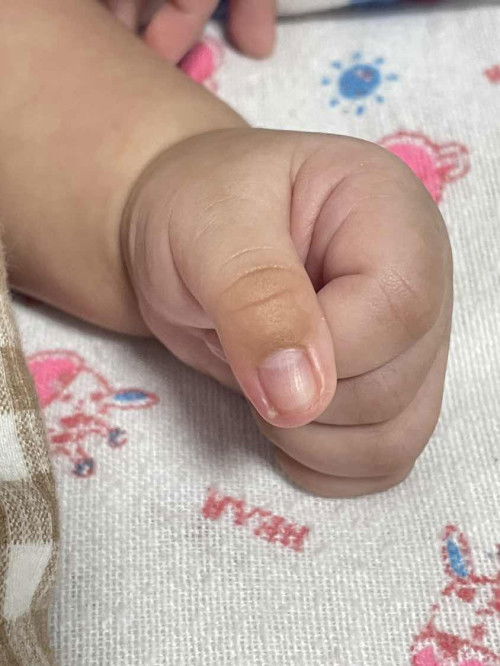 รักษาเล็บขบในทารก