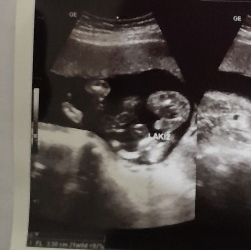 hasil usg JK janin
