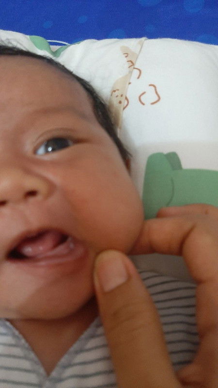 Benjolan putih digusi bayi