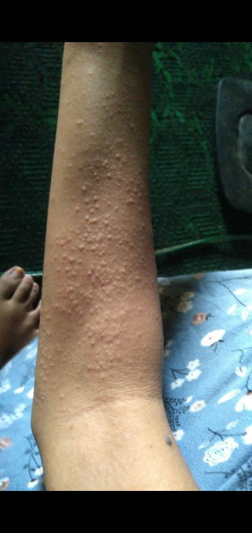 Gatal gatal saat hamil