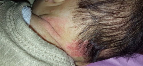 Ada ngga si Bun yg anaknya gatal2 kaya gini , pake nya salep apa ya ? Pliss dibantu jawab Bun, ?