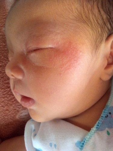 น้องน้ำตาไหล แห้งเกาะขอบตา