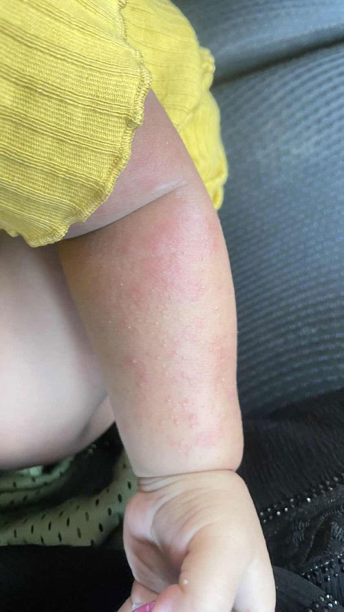 Ruam campak atau biang keringat