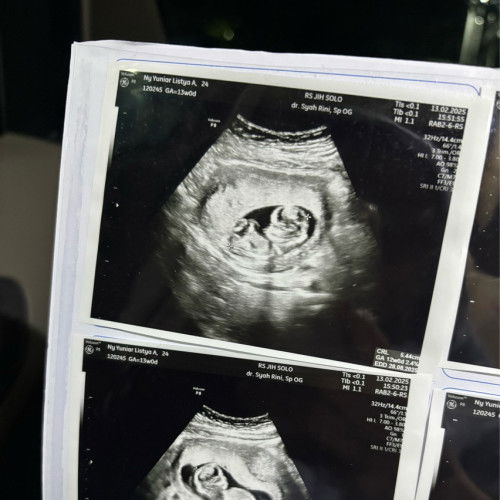 Hasil usg baby twins 13w