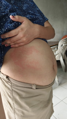 Hello mga mommies anu kaya pwede gamot sa rashes sa tiyan?