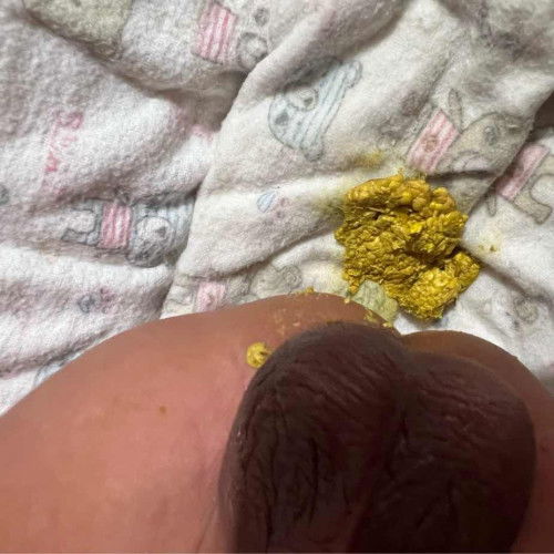 สีอึและความผิดปกติ