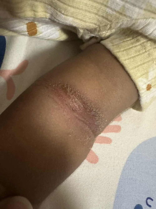 Ni ruam ke atau lain?