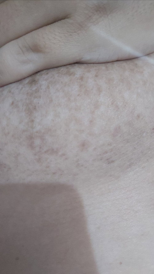Gatal di kulit payudara : jamur / Stretch Mark?