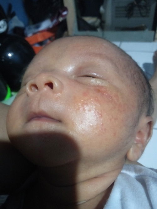 Mau tanya seputar ruam di pipi