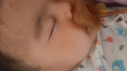 ผื่นเเดงเล็กๆบนใบหน้าลูกจะเป็นอะไรไหมค่ะแม่แม่