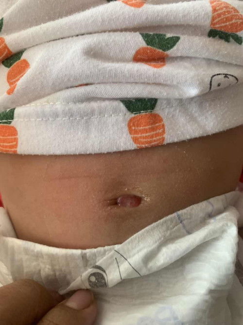 สะดือแดงแบบนี้จะหายมั้ยคะ