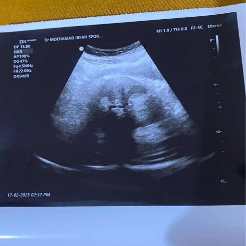 usia kandungan 4minggu tapi keluar pendarahan banyak seperti haid dan keluar gumpalan