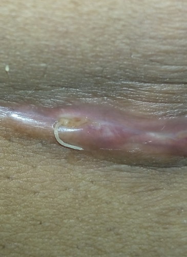 Benang putih luka czer