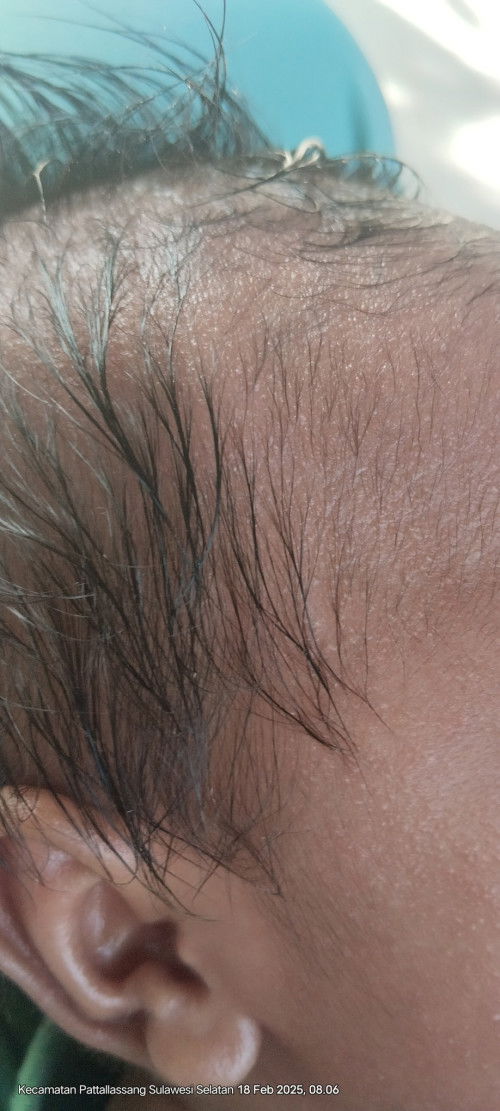 Bintik merah di  kepala dan muka